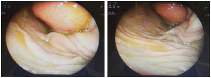 Preoperative colonoscopy showing submucosal lesion in the proximal transverse colon.