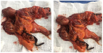 Lipomatous lesion observed in the surgical specimen obtained from enlarged right hemicolectomy.