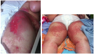 Skin lesions.
