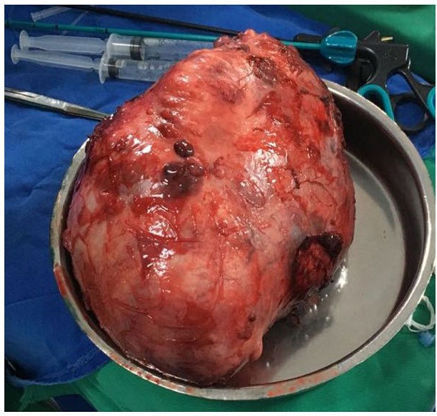 Producto de resecci&oacute;n quir&uacute;rgica: tfsp gigante de
pleura.