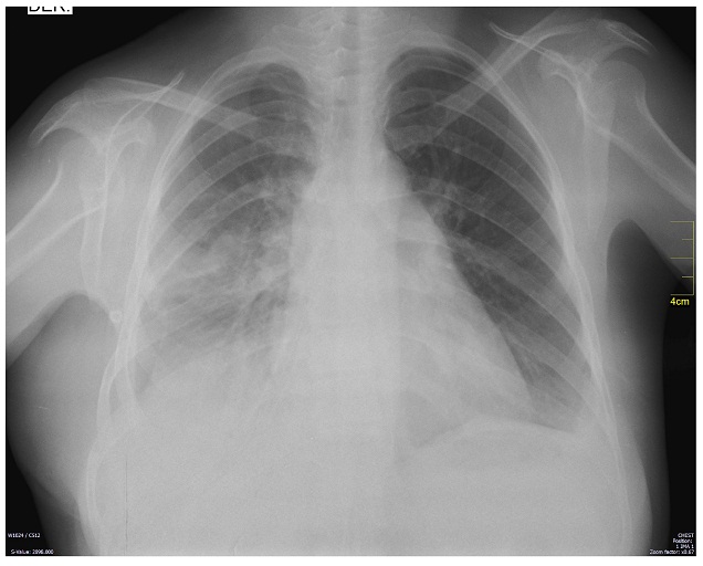  Radiograf&iacute;a de t&oacute;rax postoperatoria