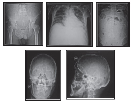 El
rastreo &oacute;seo: lesiones de tipo sacabocados