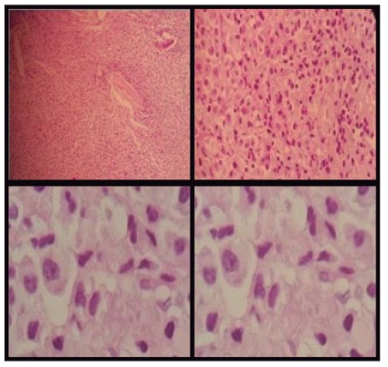  Estudio anatomopatol&oacute;gico de biopsia &oacute;sea