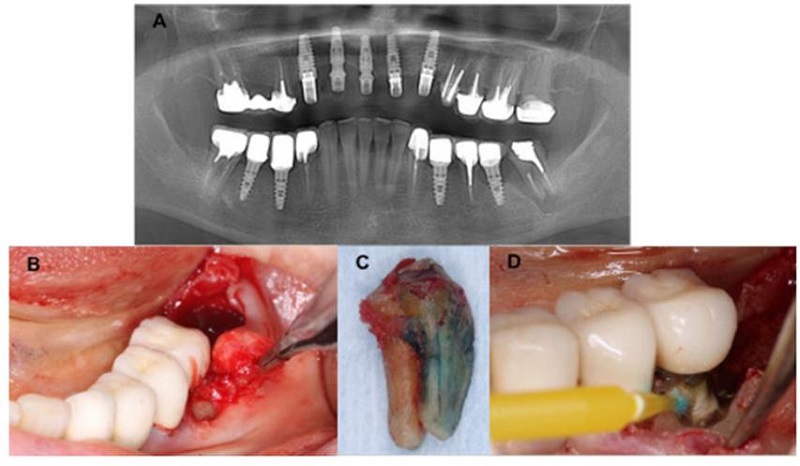 Aspecto radiográfico y clínico inicial del caso clínico. A) Ortopantomografía inicial con notoria lesión radiolúcida, fractura vertical radicular y diente previamente tratado endodónticamente en el órgano dental 37. Se identifica compromiso perimplantar del órgano dental 36. B) Exodoncia propiamente realizada en la zona de los molares posteroinferiores izquierdos. C) Órgano dentario 37, donde se evidencia la fractura vertical radicular. D) Preparación del lecho quirúrgico y detoxificación con tetraciclina del órgano dental 36