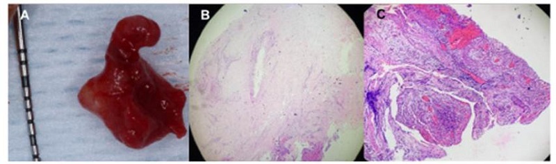 Histopatología de lesión apical del caso clínico. A) Aspecto morfológico de lesión apical del órgano dentario 37. B) Vista histológica de tejido de granulación (5X). C) Histopatología de la lesión apical con abundante presencia de infiltrado de células inflamatorias e infiltrado hemorrágico (20X)