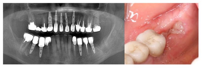 Aspecto radiográfico y clínico de caso clínico. A) Radiografía final que pone en evidencia la oseointegración en área intervenida (od 36 y 37). B) Microfotografía clínica final de control, donde se observan tejidos en cicatrización (45 días)