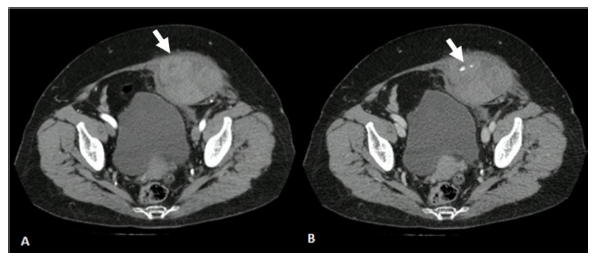 Angiotomografa de abdomen contrastada (corte transversal). A) Fase arterial, hematoma en el msculo recto abdominal izquierdo de densidad heterognea (195 x 70 x 112 mm [L x AP x T]) (flecha). B) Fase venosa, foco lineal hiperdenso correspondiente a sangrado activo (flecha)