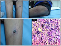 Figura 1, 2 y 3. Calcifilaxis lesin macroscpica. Figura 4. Calcifilaxis: calcificaciones, clulas gigantes multinucleadas e infiltrado inflamatorio mixto (H&E. 40X)