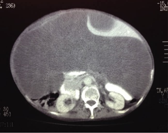 Se aprecia desplazamiento de asas intestinales y ambos riñones en sentido dorsal