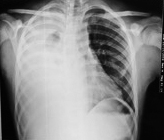 Derrame pleural masivo derecho con desplazamiento de línea media