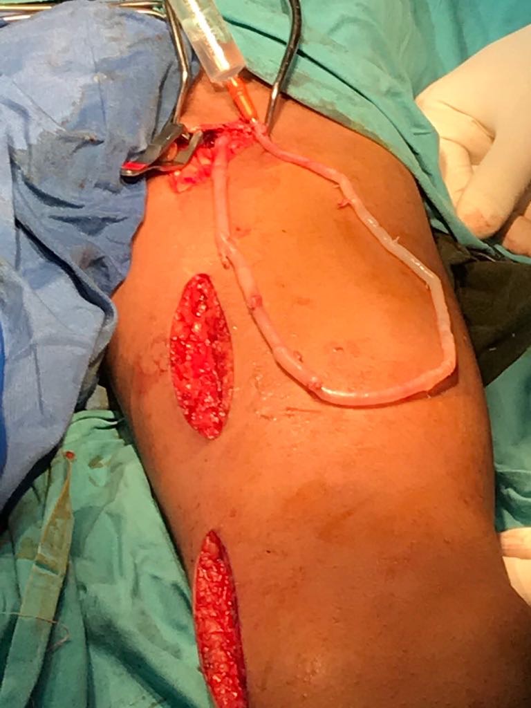 Loop Safeno-femoral izquierda