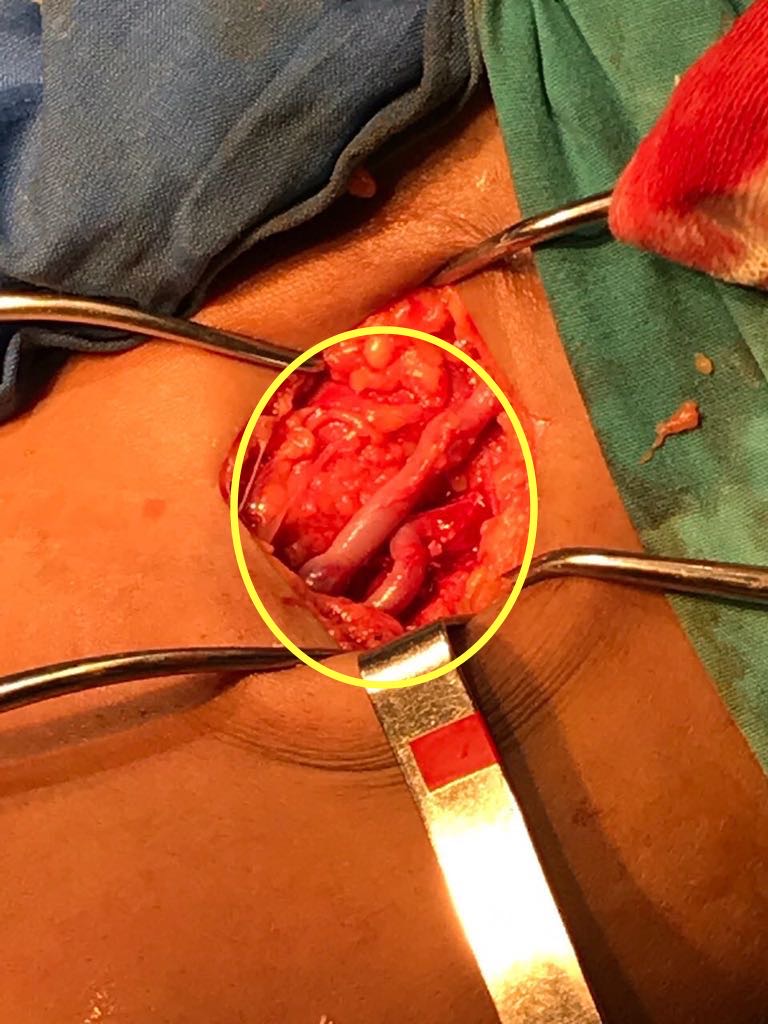 Anastomosis proximal a la AFS