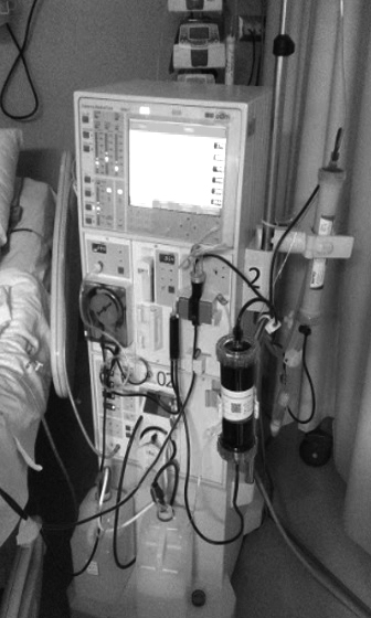 Procedimiento de hemoperfusión más hemodiálisis convencional utilizados  en los casos descritos