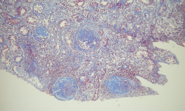 Biopsia   renal Esclerosis segmentaria y global Microscopa ptica de 11   glomrulos 8 en oblea y 3 con esclerosis segmentaria y retraccin del   penacho glomerular Tbulos con extensos sectores de atrofia y cilindros   proteicos Esclerosis intersticial en un 70% Vasos con esclerosis   subintimal tipo catfila de cebolla y arterias pequeas con   engrosamiento de pared