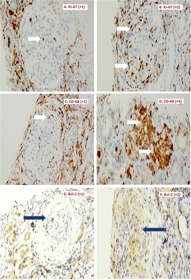 Light microscope immunohistochemical staining in crescentic area