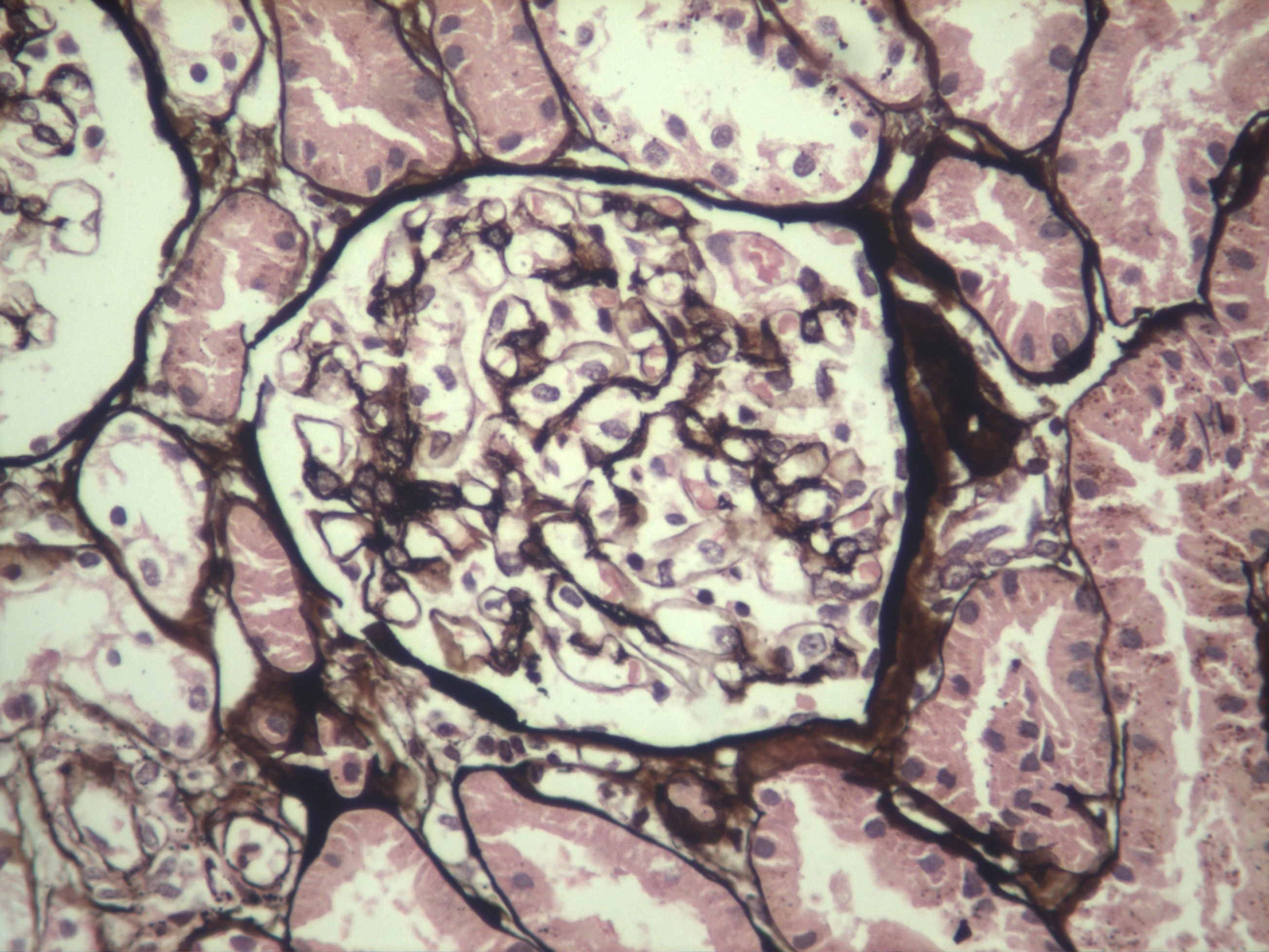 Biopsia renal