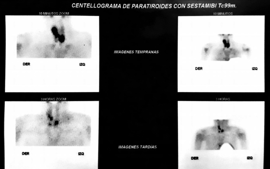 Centellograma de Paratiroides Áreas de captación selectiva en región de los polos inferiores de ambos lóbulos tiroideos