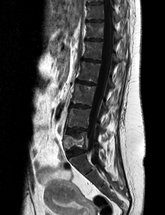 TAC de columna lumbosacra. Múltiples lesiones osteolíticas en todos los cuerpos vertebrales. Fractura patológica de L5