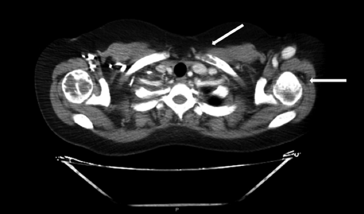TAC de tórax Lesiones en clavícula y humero izquierdo las flechas blancas señalan las más evidentes