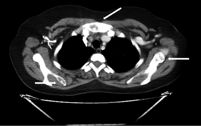 TAC de tórax. Lesiones en esternón y escapula bilateral (las flechas blancas señalan las más evidentes)