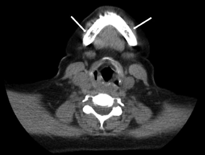 TAC de cuello Lesiones en mandíbula las flechas blancas señalan las más evidentes