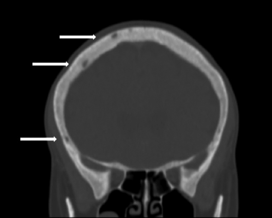TAC de cerebro. Lesiones en calota craneana (las flechas blancas señalan las más evidentes)