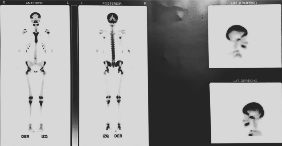 Centellograma óseo total. Revelan captación aumentada a nivel de calota craneana, maxilar inferior, vertebras dorsolumbares, cabeza de humero izquierdo, esternón, múltiples costillas, sacro, iliacos, articulaciones sacroilíacas y coxofemorales y rodillas