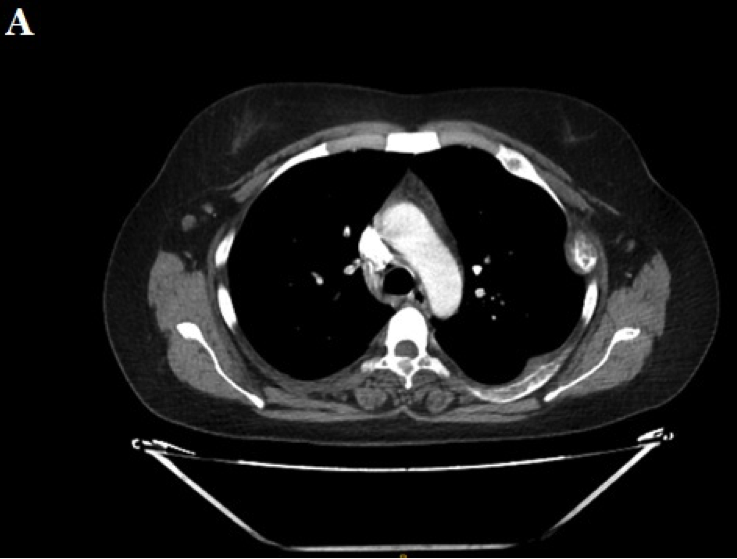 TAC de tórax. Lesiones en costillas y L5. La figura B muestra una imagen ampliada de la lesión costal