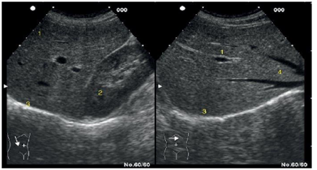 Corte longitudinal y transversal en el hipocondrio derecho: en el longitudinal (izquierda) se observa el lóbulo