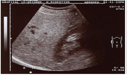 Enfermedad hepática grasa. Hígado brillante con escasa visualización de vasos intrahepáticos (grado II) 