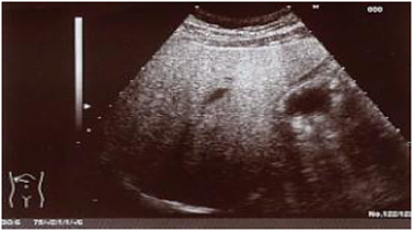 Enfermedad hepática grasa. Atenuación posterior (grado III)