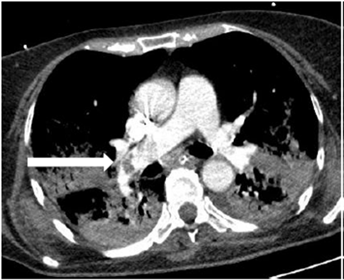 AngioTC de arterias pulmonares de un paciente con enfermedad severa (BSTI) con imagen de defecto de repleci&oacute;n (flecha) en la arteria pulmonar principal derecha
