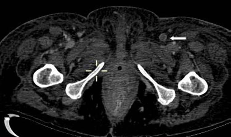 TC de abdomen donde se observa la existencia de un grueso trombo en la vena femoral com&uacute;n (flecha) derecha