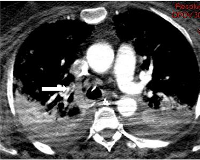 AngioTC de arterias pulmonares: Se observa una imagen de defecto de repleci&oacute;n en la arteria lobar superior derecha y ramas segmentarias (flecha)