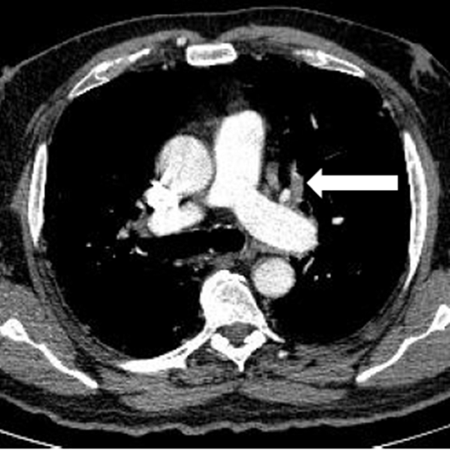 AngioTC de arterias pulmonares: Imagen de defecto de repleci&oacute;n en la vena pulmonar superior izqda.