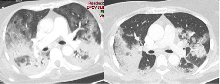 a y b. AngioTC de arterias pulmonares con ventana de pulm&oacute;n donde se puede observar la afectaci&oacute;n pulmonar severa