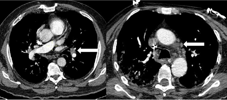 Angio TC con ventana de pulm&oacute;n en el que se observan adenopat&iacute;as hiliares (flecha izquierda) y en mediastino, en ventana aorto pulmonar (flecha derecha)
