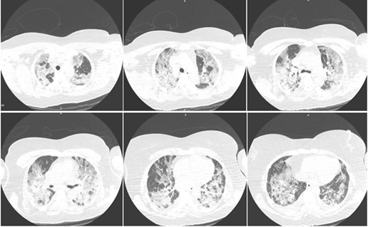 Computed tomography (CT) of a patient with COVID-19 at hospital admission.