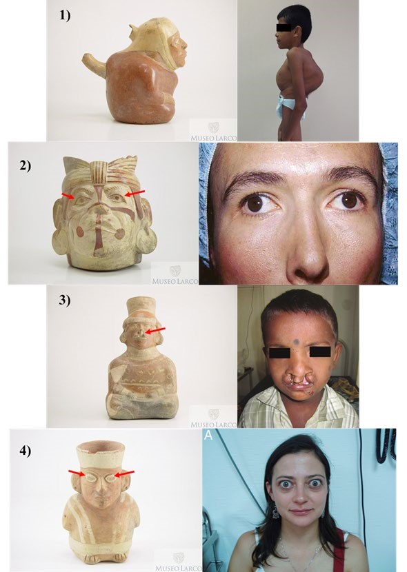 Figura 02:
Representaciones de paleopatolog&iacute;as en la cer&aacute;mica y casos actuales de las
enfermedades: 1) Cifosis lumbar (ML002747/ Arroyo 2013), 2) Estrabismo
(ML000427/ G&oacute;mez et al 2000), 3) Labio leporino (ML002707/ Kamavaram et al
2012) y 4) Orbitopat&iacute;a tiroidea (ML013975/ Vilar-Gonzales et al 2015).