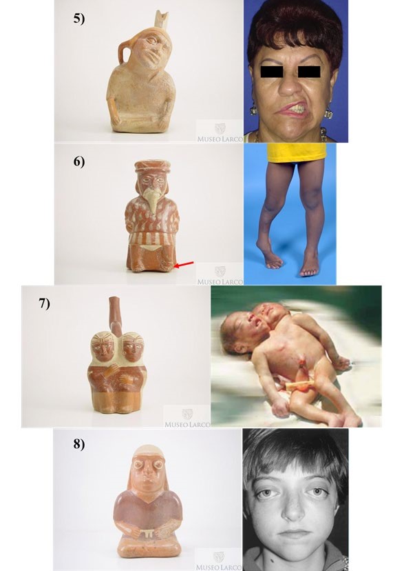Figura 03:
Representaciones de paleopatolog&iacute;as en la cer&aacute;mica y casos actuales de las
enfermedades: 5) Par&aacute;lisis facial (ML002735/Le&oacute;n-Arcilla 2013), 6) Pie de
equino varo 

(ML002733/
Orthofix y SRH 2016), 7) siameses (ML002639/ Garc&iacute;a et al 2009) y 8) S&iacute;ndrome
de Crouzon (ML013642)