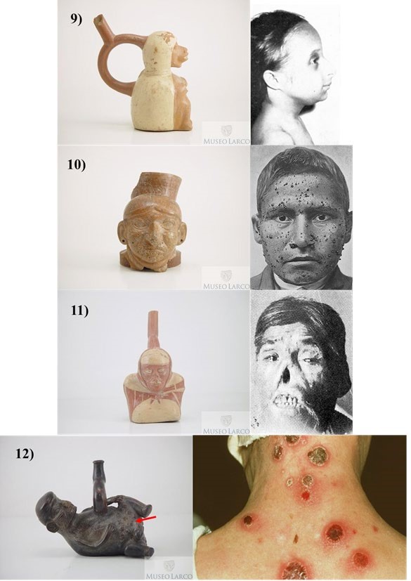 Figura 04:
Representaciones de paleopatolog&iacute;as en la cer&aacute;mica y casos actuales de las
enfermedades: 9) Sindrome de Seckel (ML002711/ Iborra y Fern&aacute;ndez 1977), 10)
Bartolenosis 

(ML002643/
Cueto 2007), 11) Leishmaniasis (ML012990/ Weiss 1943) y 12) Sifilis (ML004300/
D&iacute;ez 2016)
