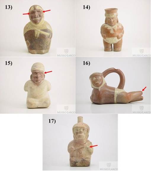 Figura 05:
Representaciones de paleopatolog&iacute;as en la cer&aacute;mica: 13) Discapacidad visual 

(ML002810),
14) Obesidad (ML002635), 15) Tuerto (ML002806), 16) Mutilaci&oacute;n de miembros
inferiores (ML001391/) y 17) Mutilaci&oacute;n de miembros superiores (ML001467).