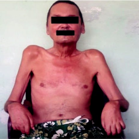 Atrofia muscular marcada en los miembros superiores con distribuci&oacute;n proximodistal
