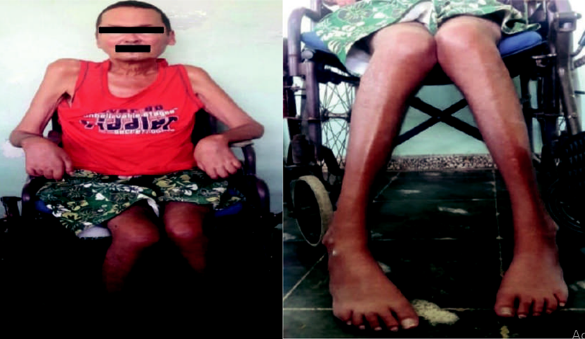 Atrofia muscular marcada con distribuci&oacute;n proximodistal.