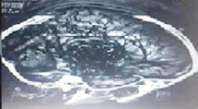 Segunda resonancia magnética nuclear