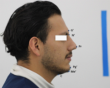 Determinaci�n de puntos en el contorno del perfil facial derecho: Glabela (G&rsquo;) punto m�s sobresaliente de la frente; Nasion (N&rsquo;) ra�z de la nariz, Pronasale (Pr) punta m�s anterior y prominente de la nariz, Pogonion (Pg&rsquo;) punto m�s anterior del ment�n, Ment�n (Me&rsquo;) punto m�s inferior de la regi�n mentoniana y Cervical (C) punto m�s profundo formado por la intersecci�n del �rea submandibular y el cuello.