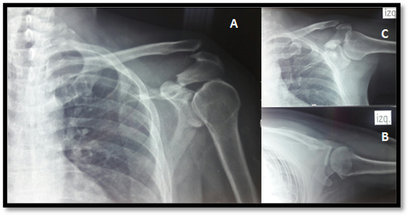 Radiograf&iacute;as iniciales evidencian una fractura desplazada del acromion tipo II de Kuhn y una luxaci&oacute;n acromioclavicular grado III de rockwood. Proyecci&oacute;n anteroposterior de hombro (A), lateral (B), axilar (C).
