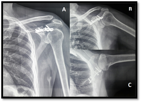 Radiograf&iacute;as de control a las cinco semanas, luego de la remoci&oacute;n de las clavijas. Proyecci&oacute;n anteroposterior de hombro (A), Lateral (B), axilar (C).