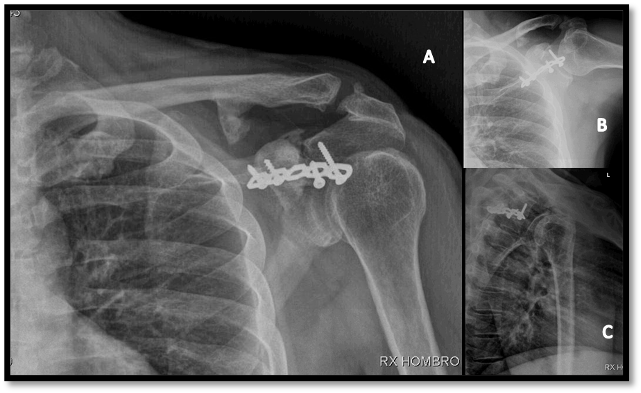 Radiograf&iacute;as de control a los 12 meses postquir&uacute;rgicos, muestran signos de consolidaci&oacute;n &oacute;sea, y congruencia articular acromiocavicular. Proyecci&oacute;n anteroposterior de hombro (A), Lateral (B), Transtor&aacute;cica (C).