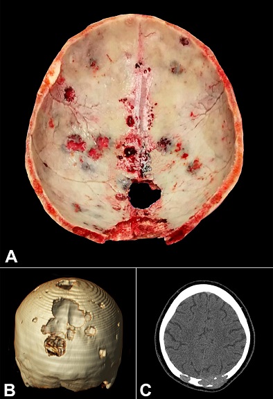 A – Gross appearance of the calvarium obtained at autopsy showing multiple bone lytic lesions (“punched out,” “pepper pot skull,” or “raindrop skull”) ranging from 0.5 cm to 2.5 cm in diameter, filled by fleshy, soft tissue. B – Computed tomography (CT) of the brain (3D reformation) showing multiple lytic lesions, which are more prominent in the occipital area. C – Axial brain CT showing bone lytic lesions invading soft tissues.